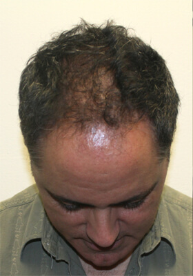 hair transplant photos