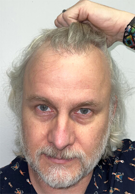 hair transplant photos