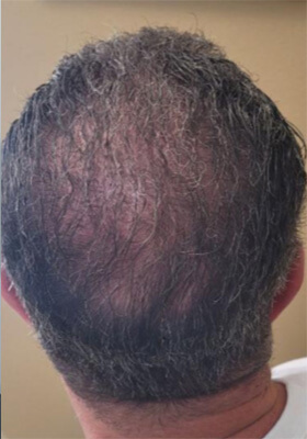 hair transplant before after Photos