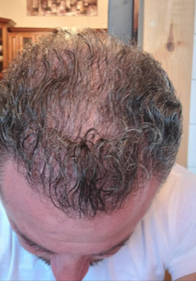 hair transplant photos