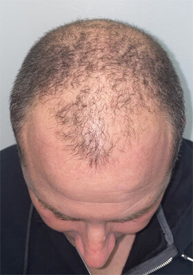 hair transplant photos