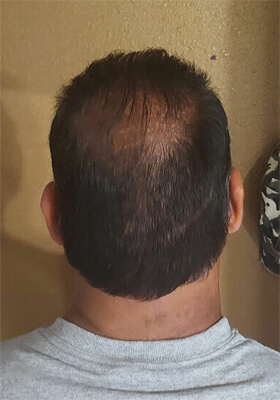 hair transplant before after Photos