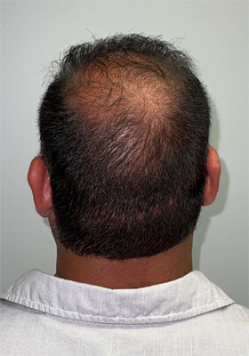 hair transplant before after Photos