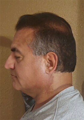 hair transplant photos