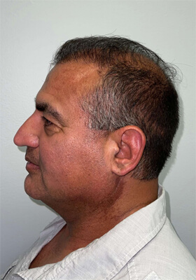 hair transplant before after Photos