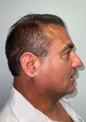 hair transplant before after Photos