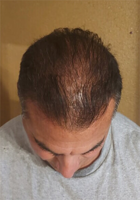 hair transplant photos