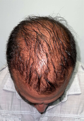 hair transplant photos