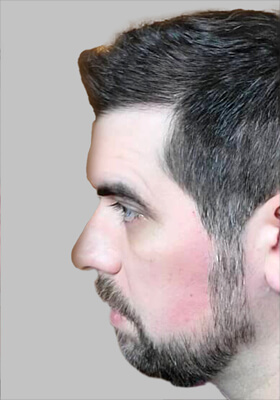 hair transplant photos