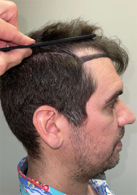 hair transplant before after Photos