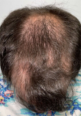 hair transplant photos