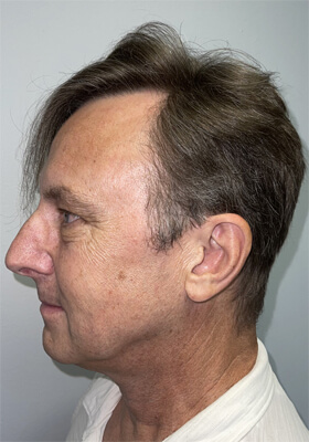 hair transplant before after Photos