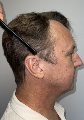 hair transplant photos