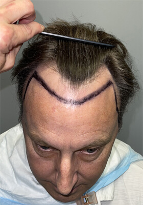 hair transplant before after Photos