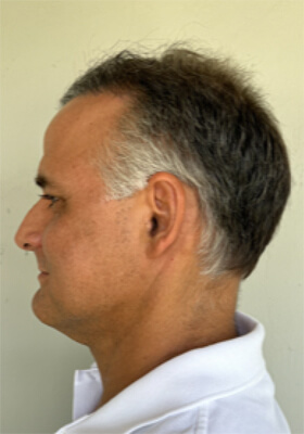 hair transplant photos