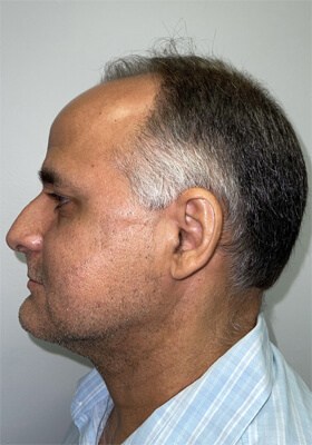 hair transplant before after Photos