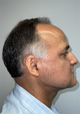 hair transplant before after Photos