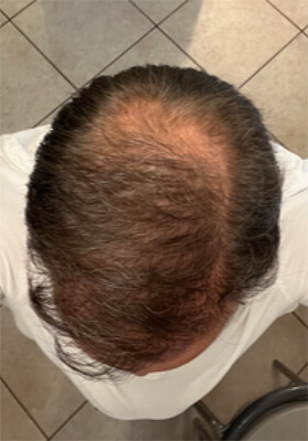 hair transplant photos