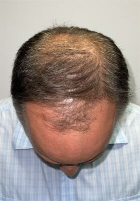 hair transplant photos