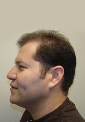 hair transplant before after Photos