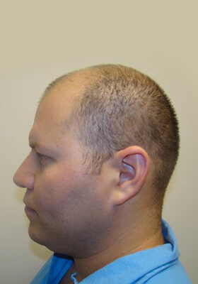 hair transplant before after Photos