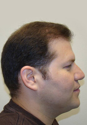 hair transplant before after Photos