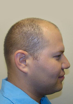 hair transplant before after Photos