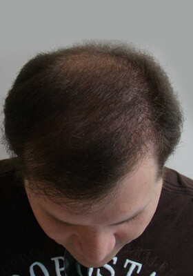 hair transplant before after Photos