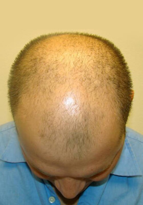 hair transplant photos