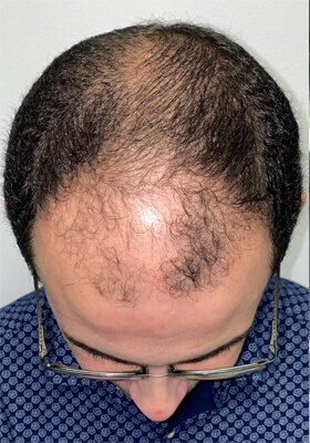 hair transplant photos