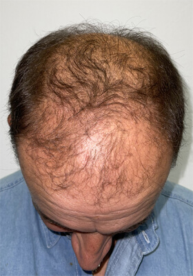 hair transplant before after Photos