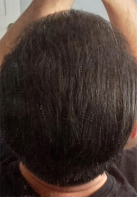 hair transplant before after Photos