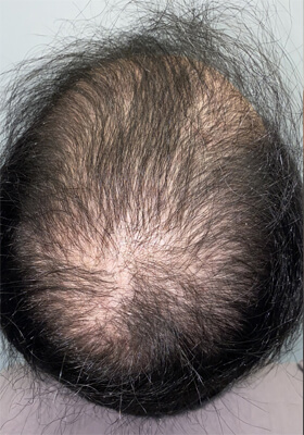 hair transplant before after Photos