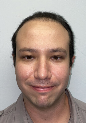 hair transplant photos