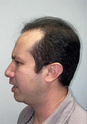 hair transplant photos