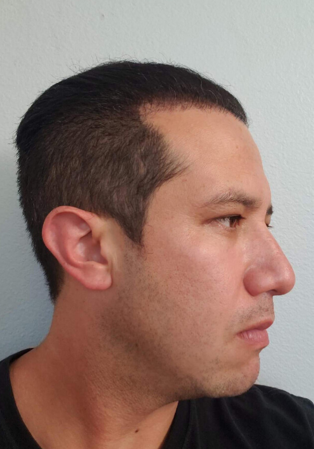 hair transplant before after Photos