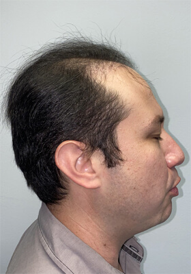 hair transplant before after Photos