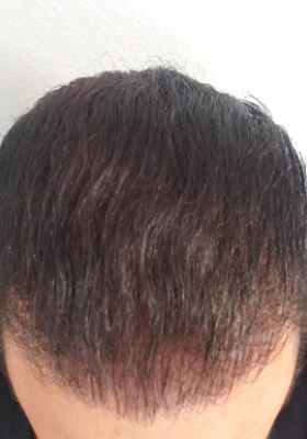 hair transplant before after Photos