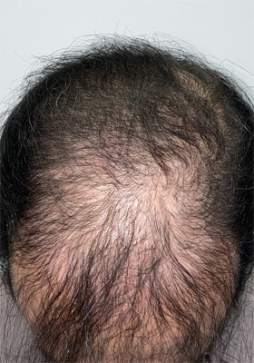 hair transplant before after Photos