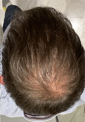 hair transplant before after Photos