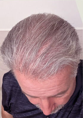 hair transplant photos