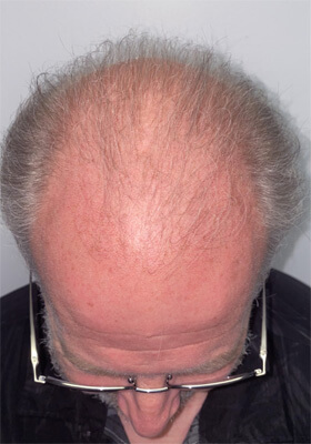 hair transplant before after Photos