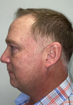 hair transplant photos