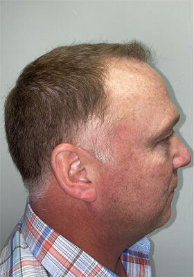 hair transplant photos