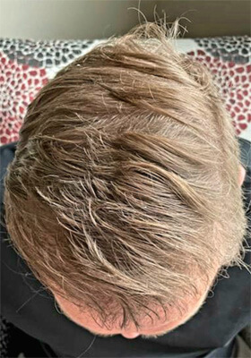 hair transplant photos