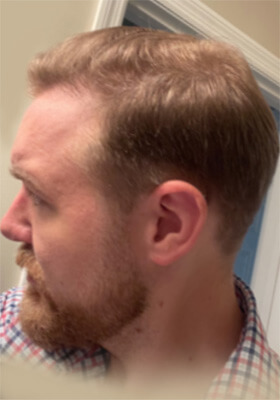 hair transplant before after Photos