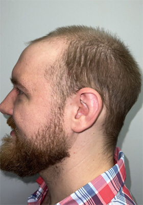 hair transplant photos