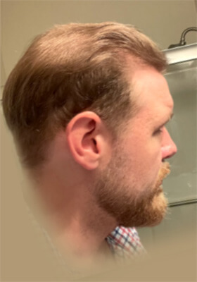 hair transplant before after Photos