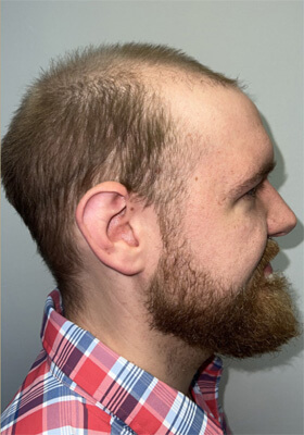 hair transplant photos