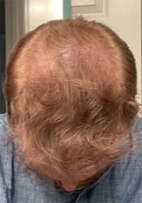 hair transplant photos